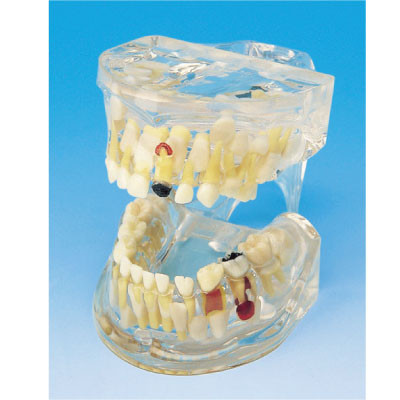 透明乳歯疾患模型 (6歳児)