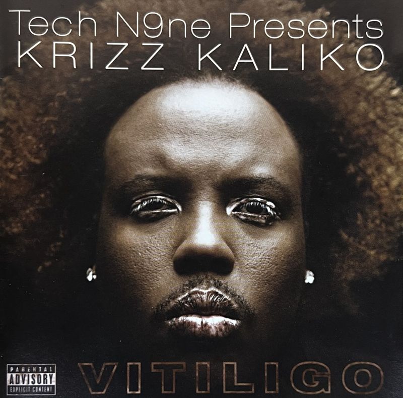 KRIZZ KALIKO / VITILIGO