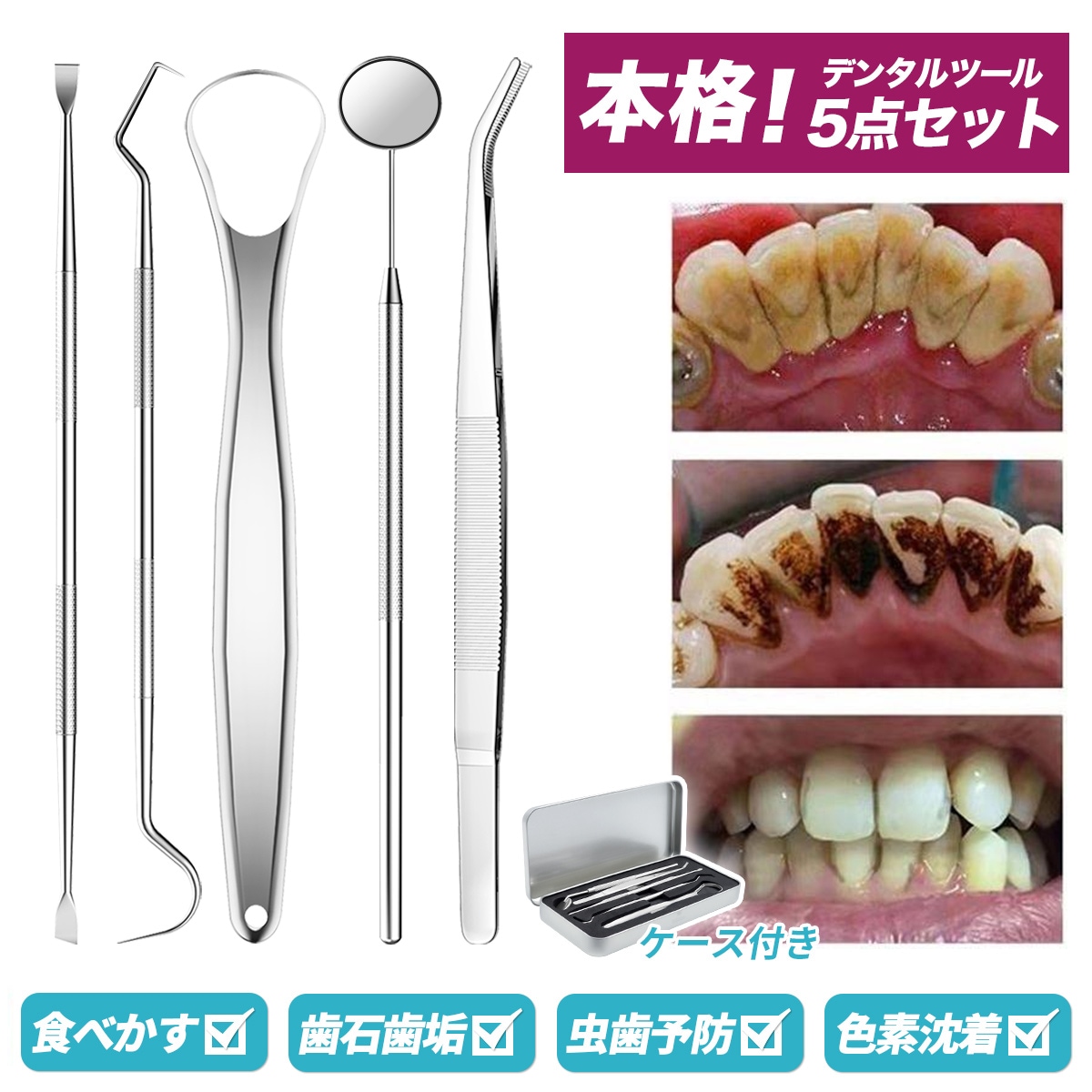 スケーラー 歯石取り-ME016