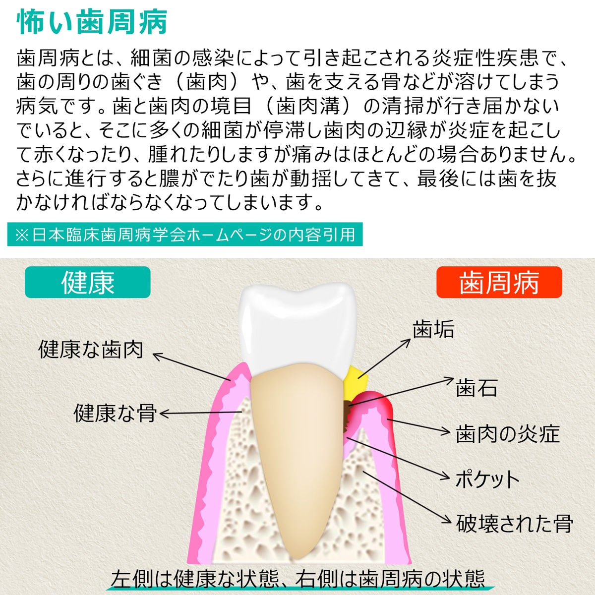 スケーラー 歯石取り-ME016