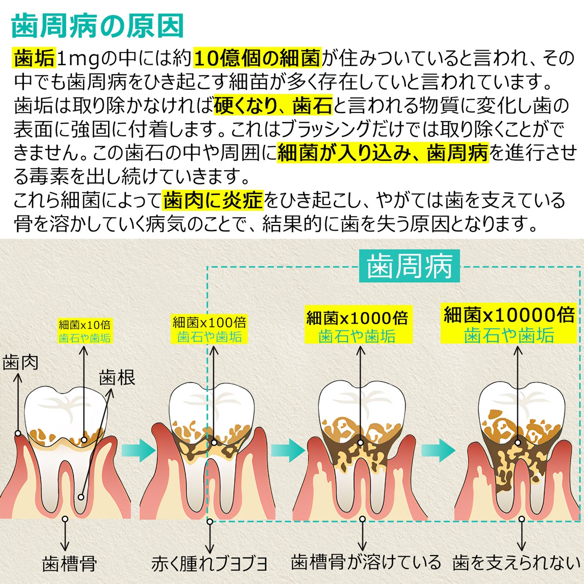 スケーラー 歯石取り-ME016