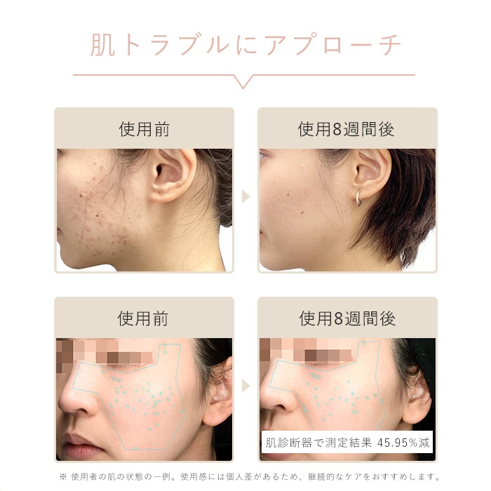 ＜ホリデーコレクション2025＞IPL光美容器 Luna