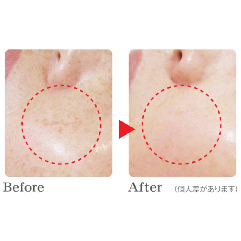 シミケア機器 REAGE（リアージュ）シミ・そばかす・肝斑の通販｜美セラ