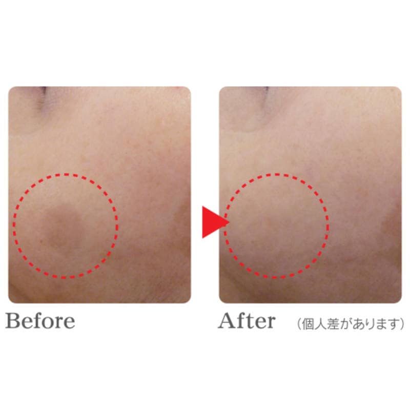 シミケア機器 REAGE（リアージュ）シミ・そばかす・肝斑