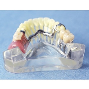 保険義歯・ノンクラスプ・インプラント比較模型