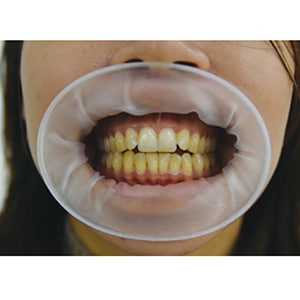 オーラルゲート