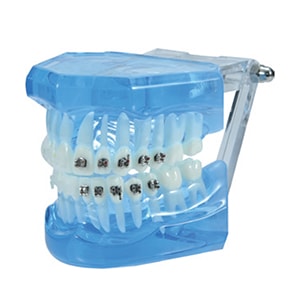 歯列矯正模型(セラミック・メタルブラケット付)