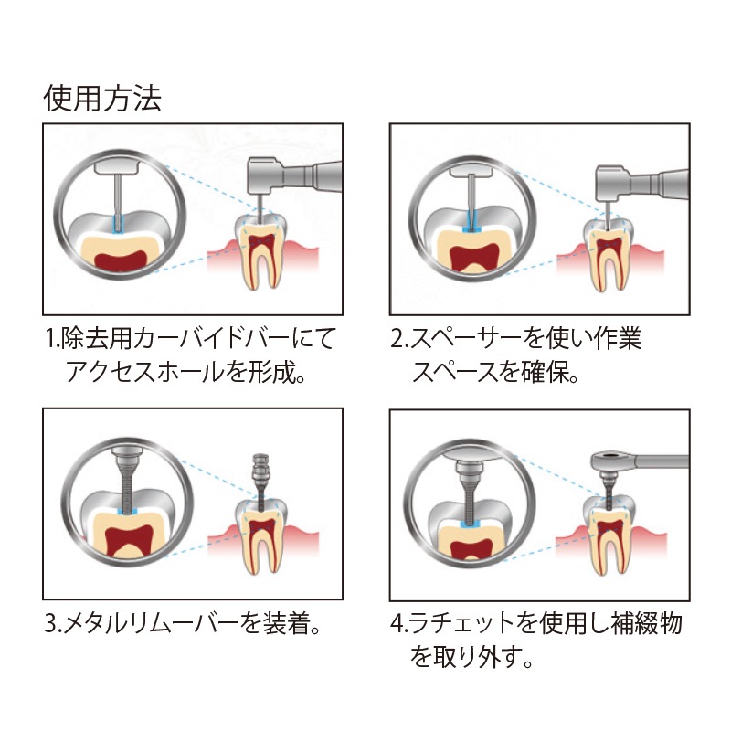 ECR(イージークラウンリムーバー) セット[Forest-one] | インスツル
