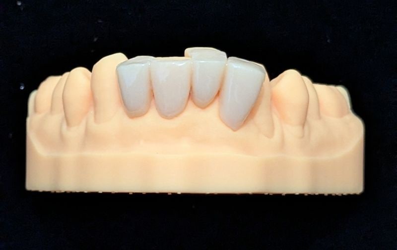 スタンダード_下の前歯_4本連結
