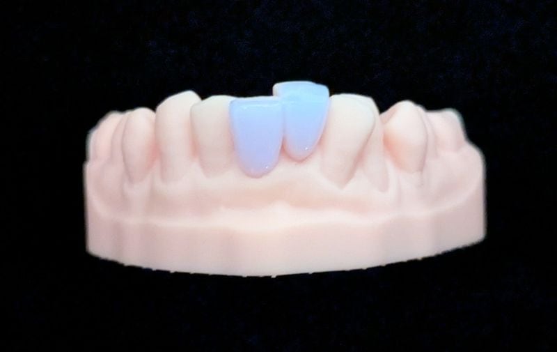 スタンダード_下の前歯_2本連結