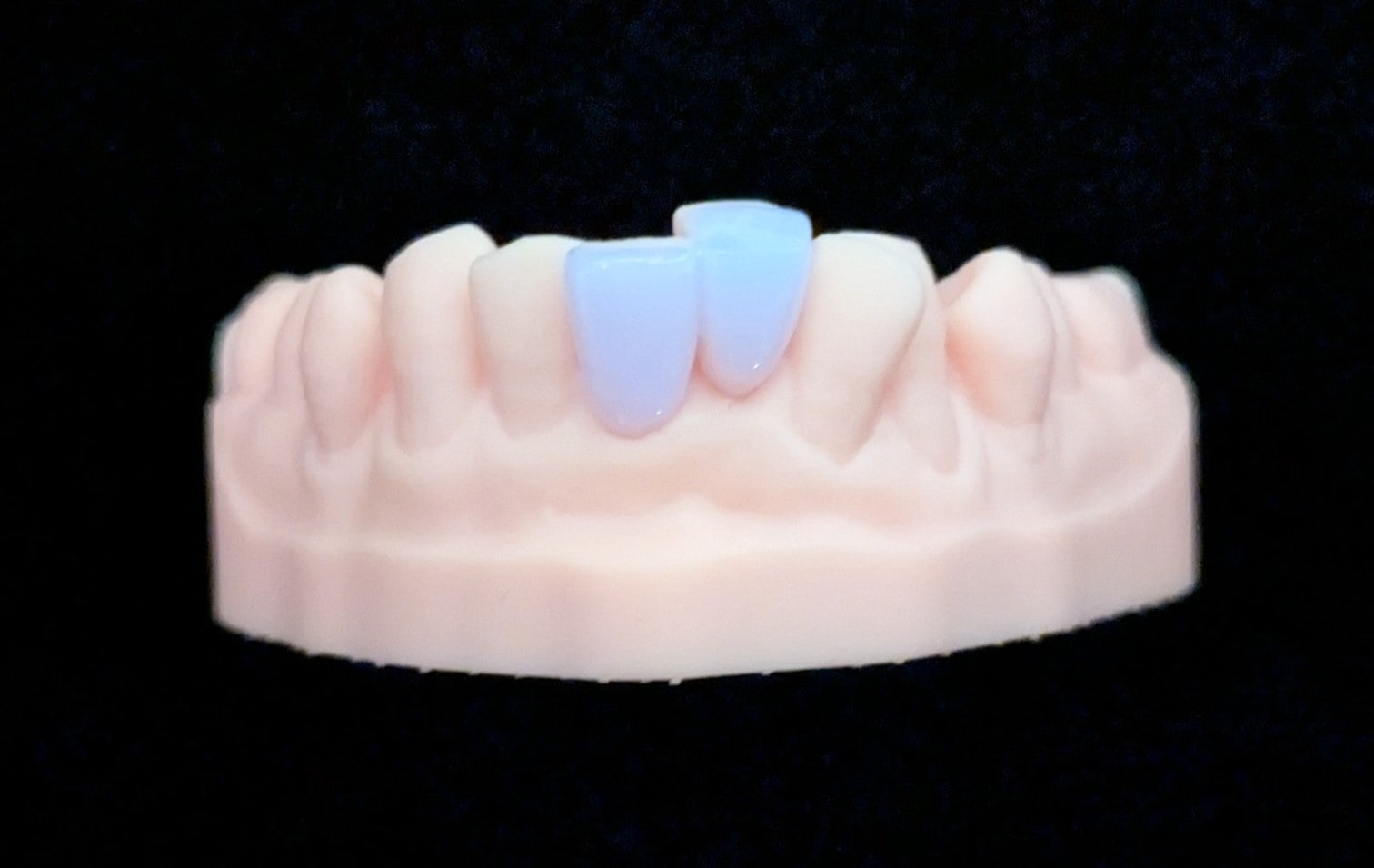 スタンダード_下の前歯_2本連結