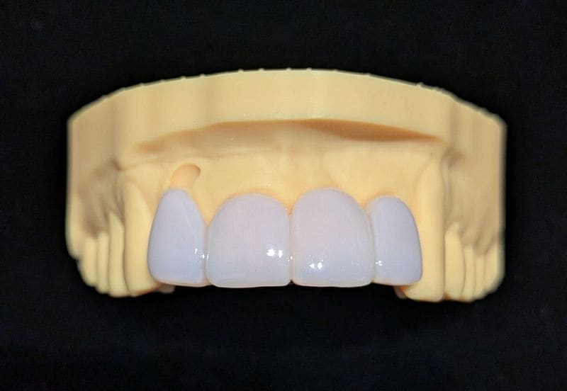 スタンダード_上の前歯_4本連結