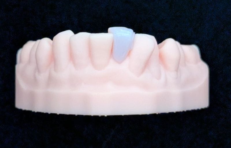 オーダーメイド_下の前歯_1本