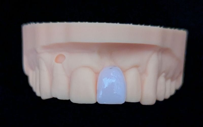 オーダーメイド_上の前歯_1本