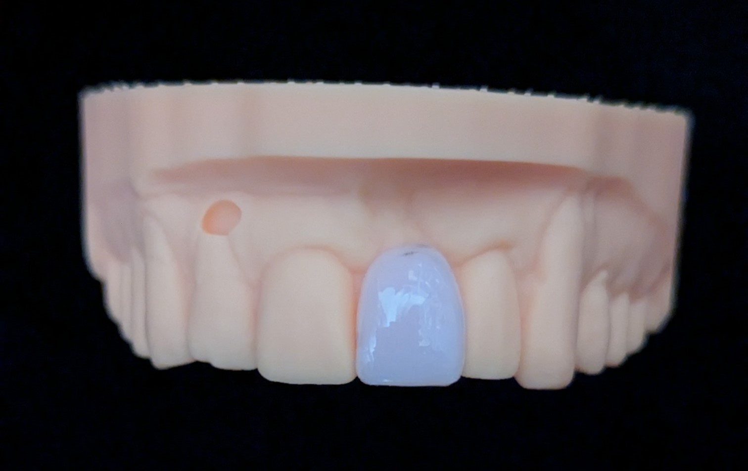 オーダーメイド_上の前歯_1本