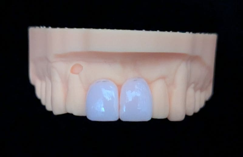 オーダーメイド_上の前歯_2本連結