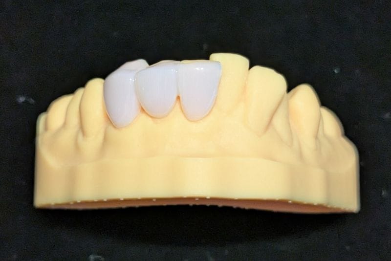 オーダーメイド_下の前歯_3本連結