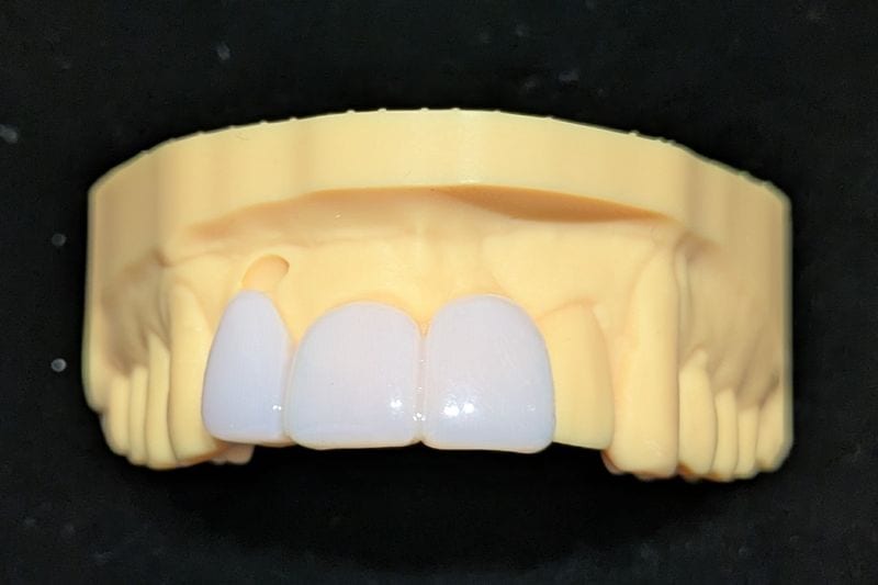 オーダーメイド_上の前歯_3本連結