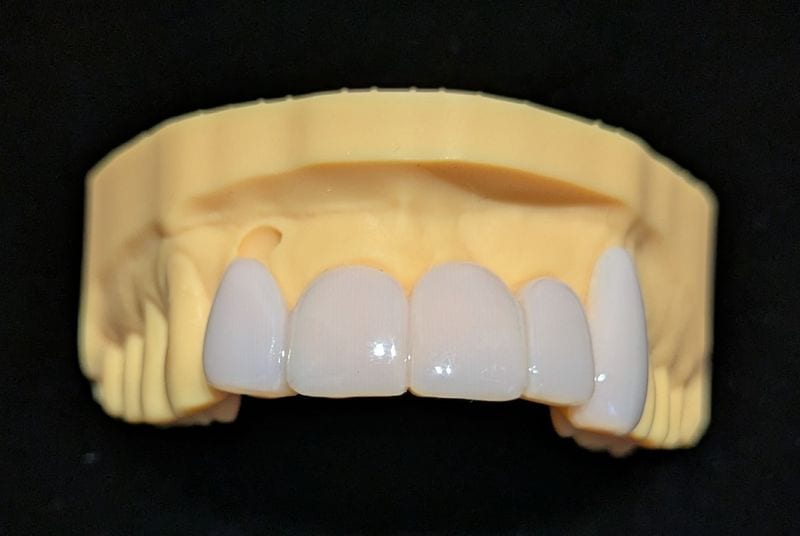 オーダーメイド_上の前歯_5本連結