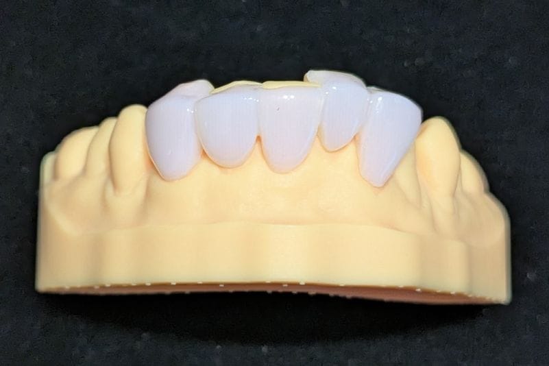 オーダーメイド_下の前歯_5本連結