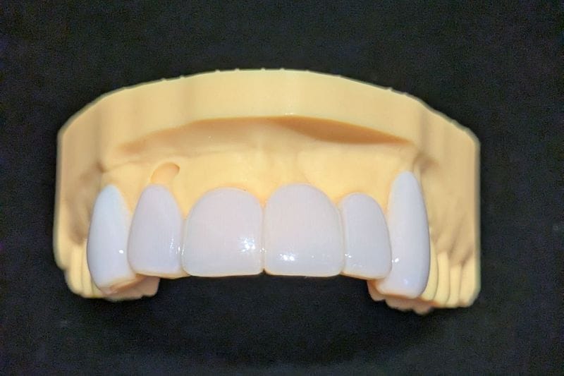 オーダーメイド_上の前歯_6本連結