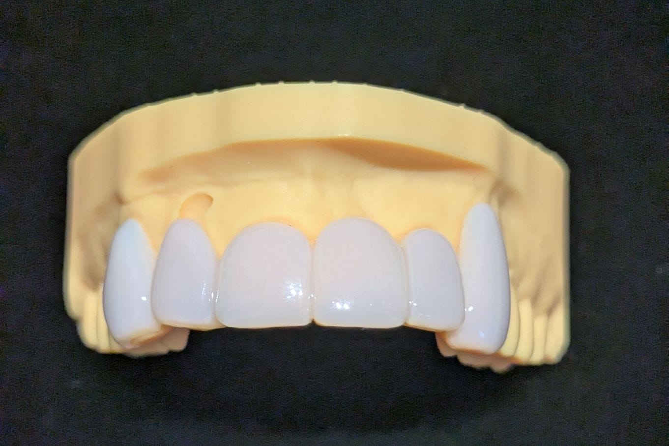 スタンダード_上の前歯_6本連結