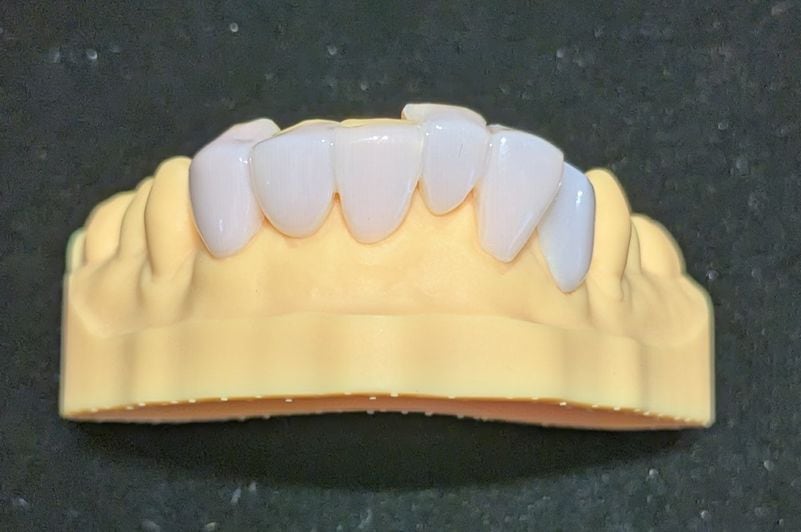 スタンダード_下の前歯_6本連結