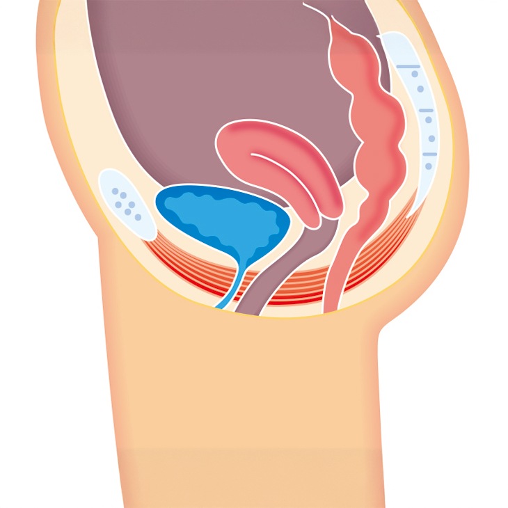 一般医療機器 骨盤底筋ショーツ モレナレディ