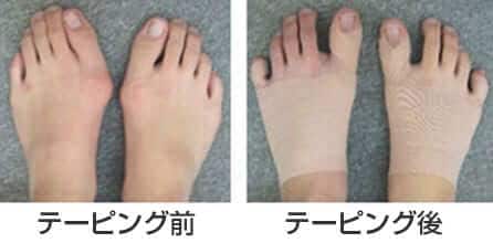 【数量限定バンテージ付き】カサハラ式　カット済足裏バランスケアテープ(片足20セット）/AKO-013