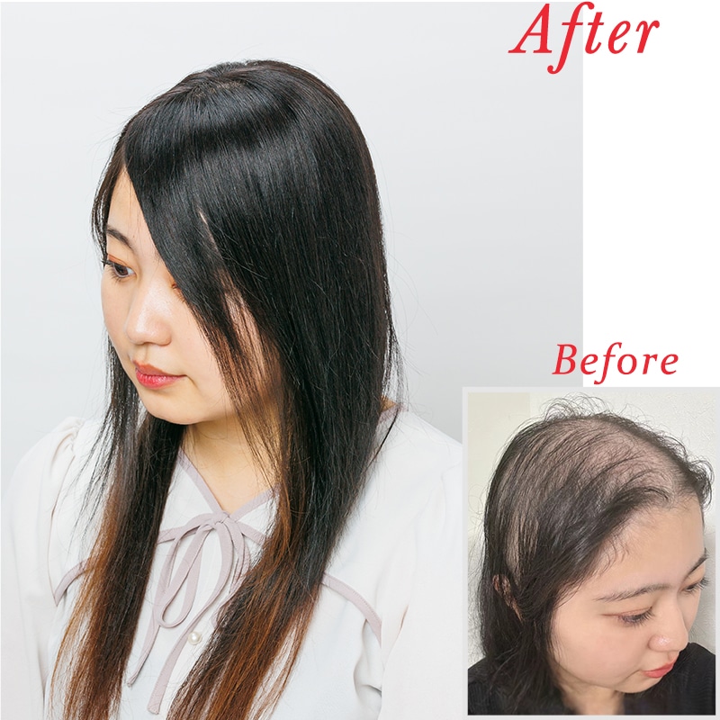 公式】私元気ウィッグ専門店 | 最高級 レミーヘア 【大面積 10×12cm