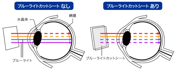 OverLay Eye Protector for ASUS ZenPad 10 (Z301MFL / Z300CL / Z300C / Z300M) 