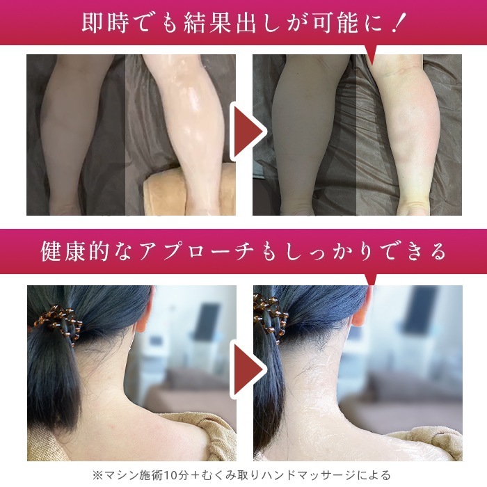 RADI CRUSH|1MHzマルチポーラ式ラジオ波と強力吸引で圧倒的