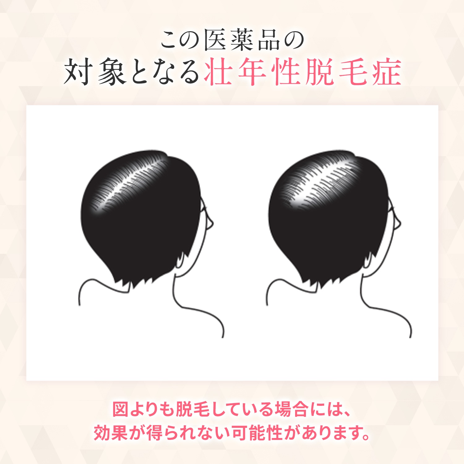 【第1類医薬品】MXプラスローションLa 60ml ミノキシジル 女性 ミノキシジル1% 医薬品 市販 発毛剤 女性用 40代 50代 60代