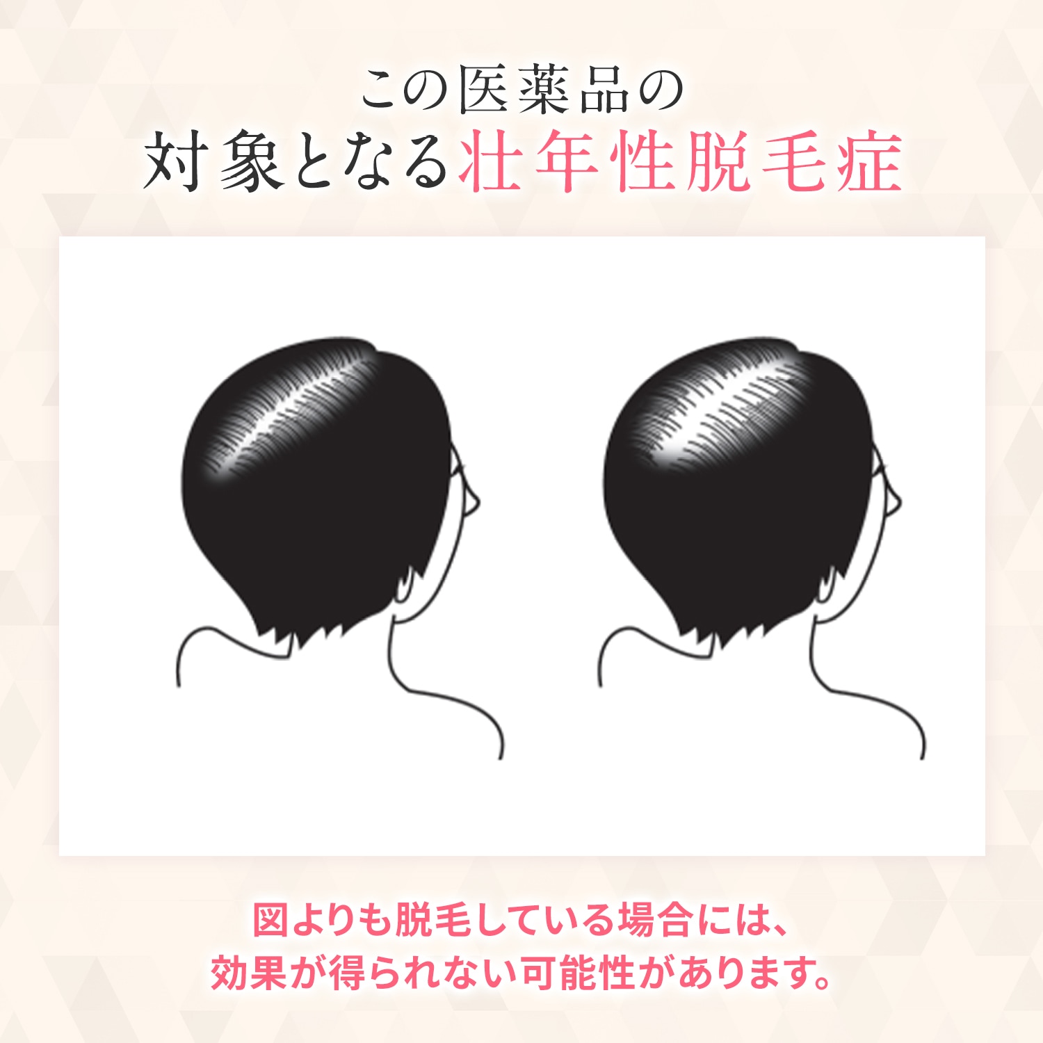 【第1類医薬品】MXプラスローションLa 60ml 3本セット | ミノキシジル 女性 ミノキシジル1% 医薬品 市販 発毛剤 女性用 40代 50代 60代