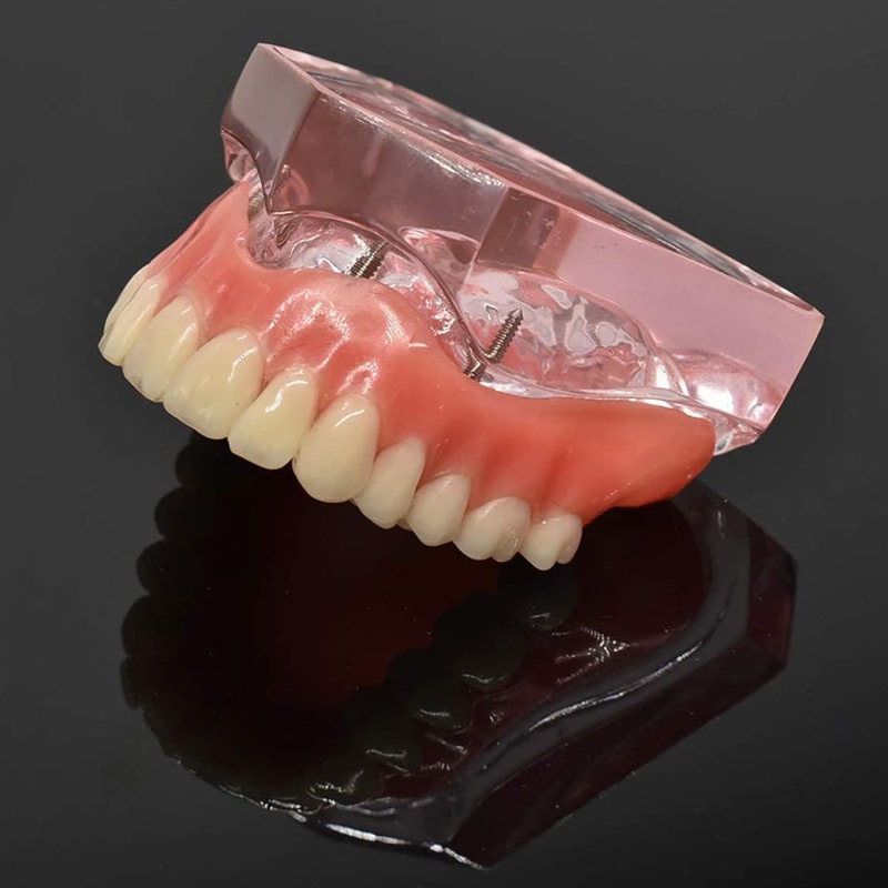 上顎模型 4本インプラント