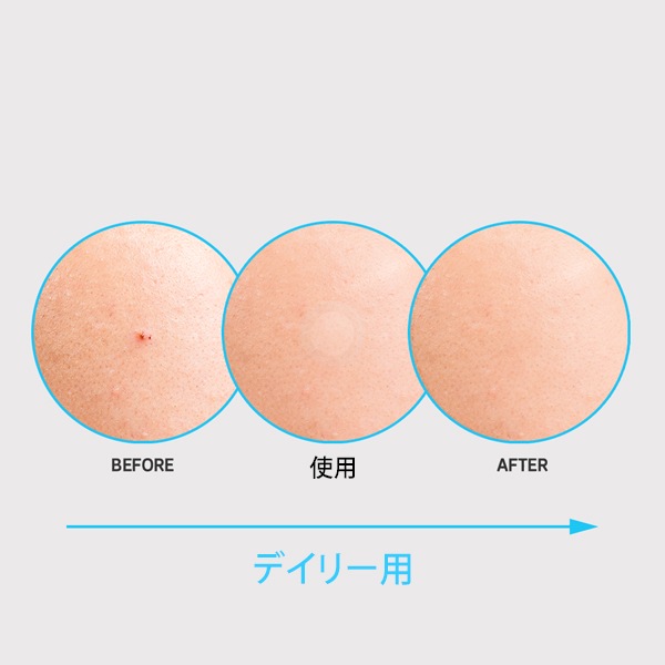 [NOLAHOUR] ニキビパッチ スポットイレイザー  63枚入り / ブルー step2