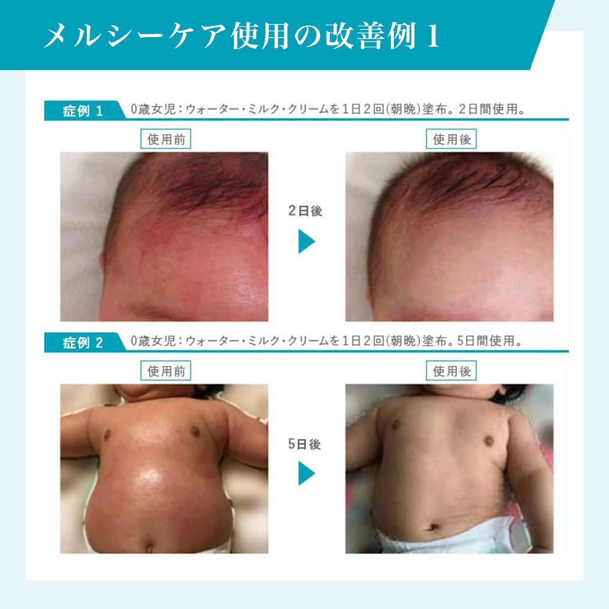 薬用メルシーケア 3点セット（浸透保水液＋薬用保湿乳液＋薬用保護クリーム）