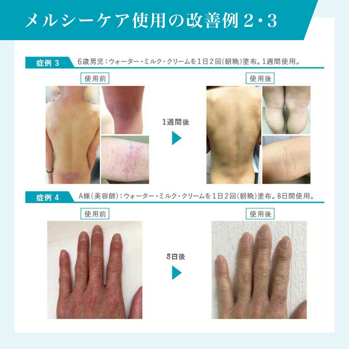 薬用メルシーケア 3点セット（浸透保水液＋薬用保湿乳液＋薬用保護クリーム）