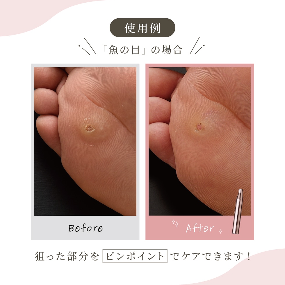 【ネコポス対応】角質ケアスティック SILHEAL(シルヒール)